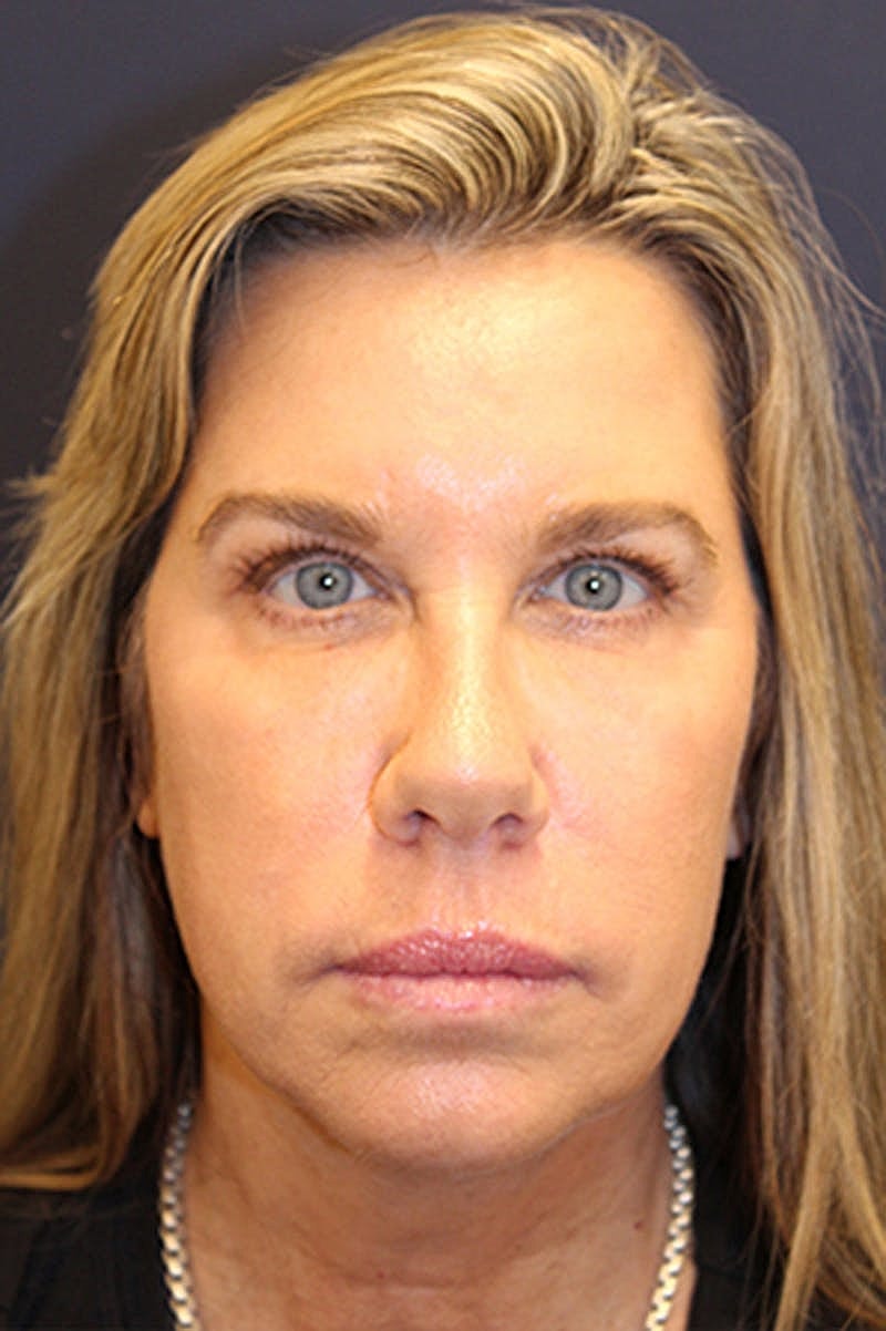 Dermal Fillers Before & After