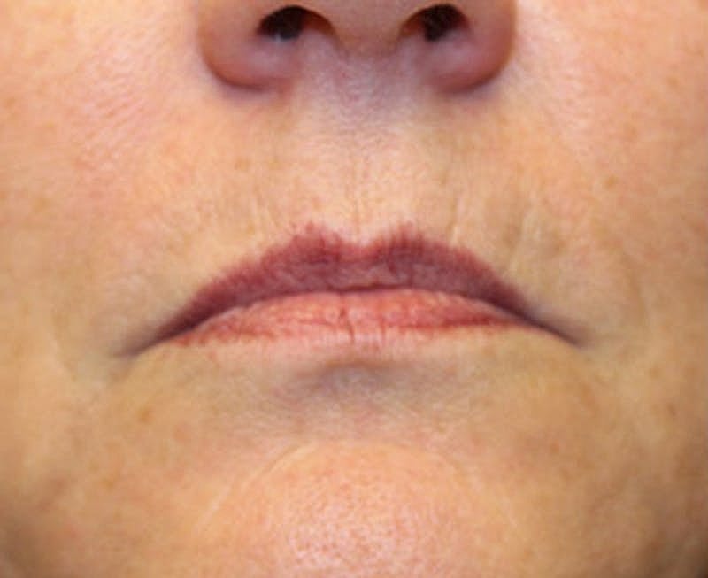 Dermal Fillers Before & After