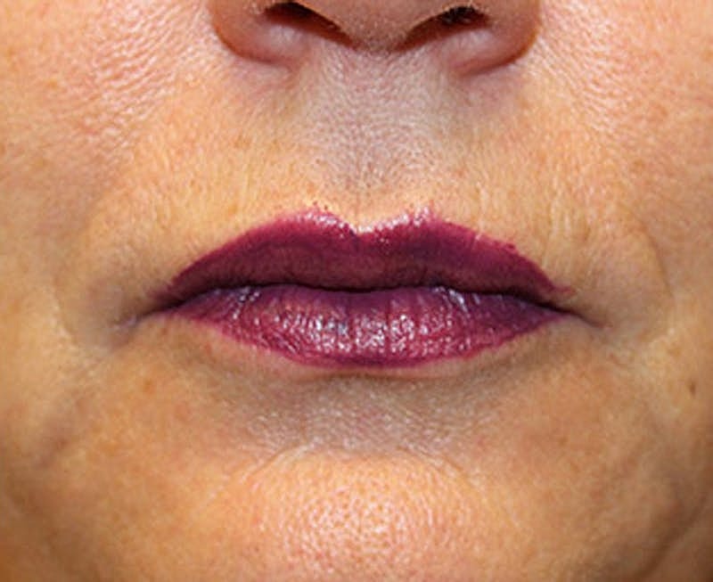 Dermal Fillers Before & After