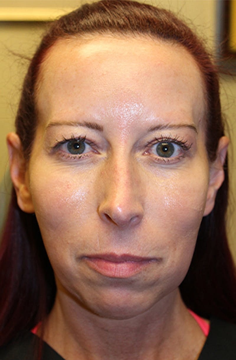 Dermal Fillers Before & After