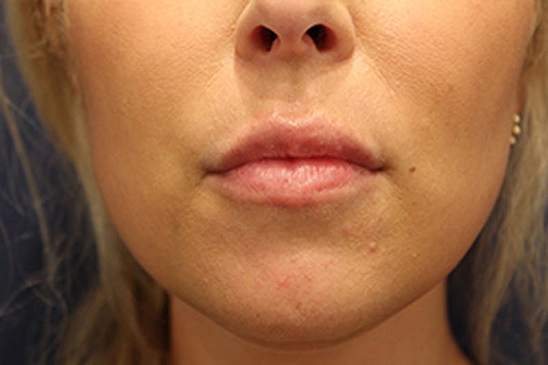 Dermal Fillers Before & After