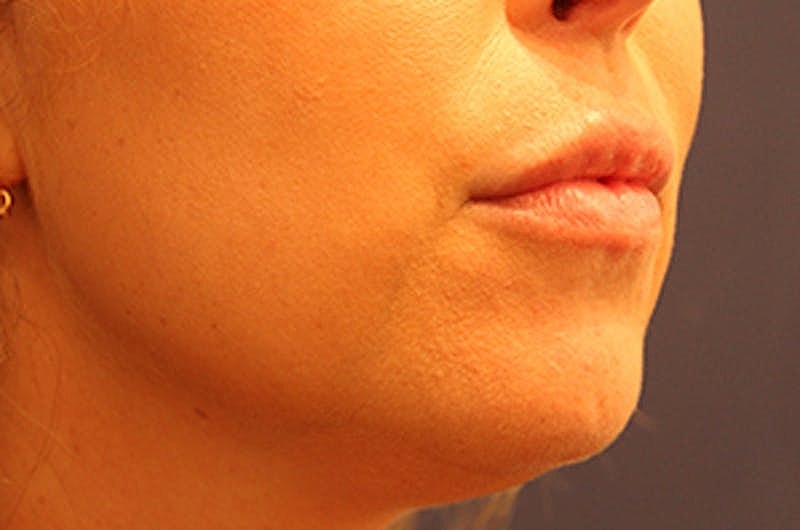 Dermal Fillers Before & After