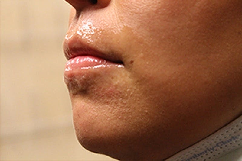 Dermal Fillers Before & After