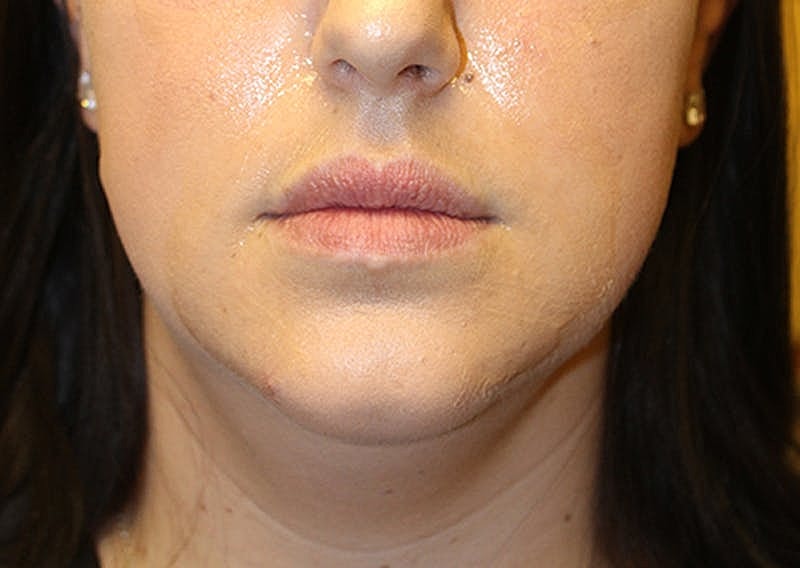 Dermal Fillers Before & After