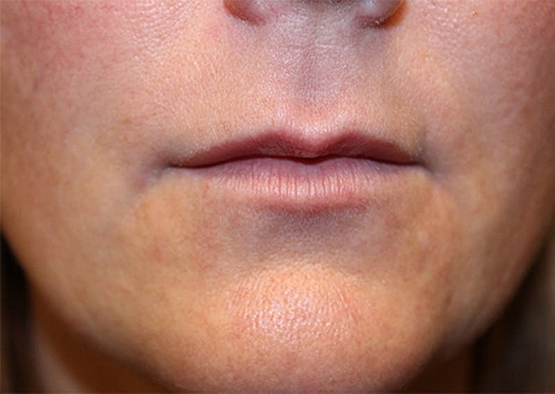 Dermal Fillers Before & After