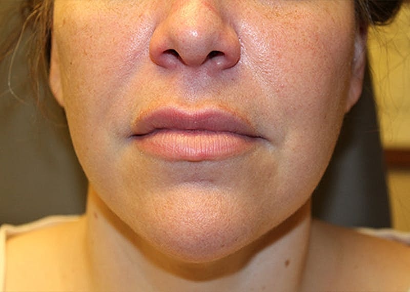 Dermal Fillers Before & After