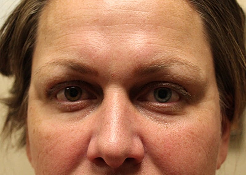 Dermal Fillers Before & After