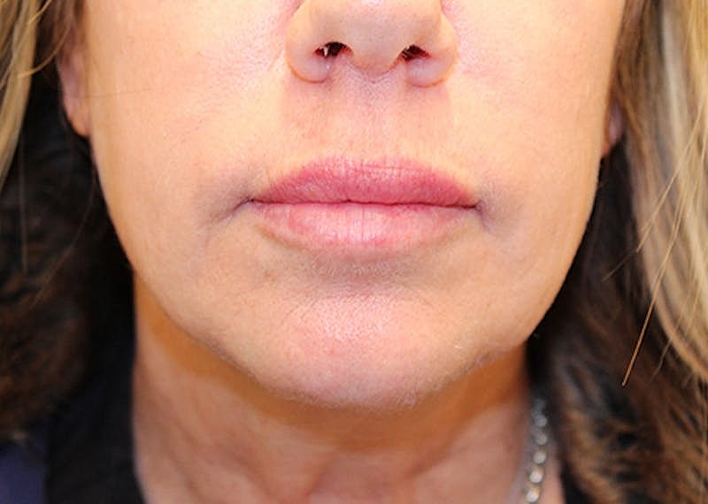 Dermal Fillers Before & After