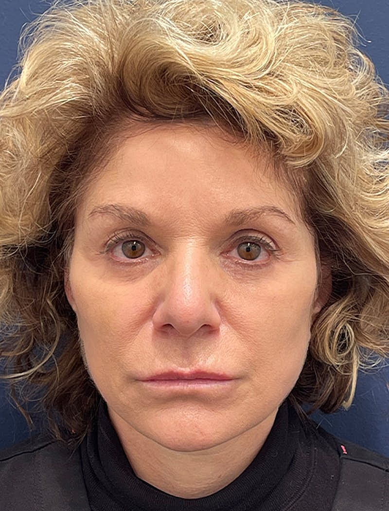 Dermal Fillers Before & After