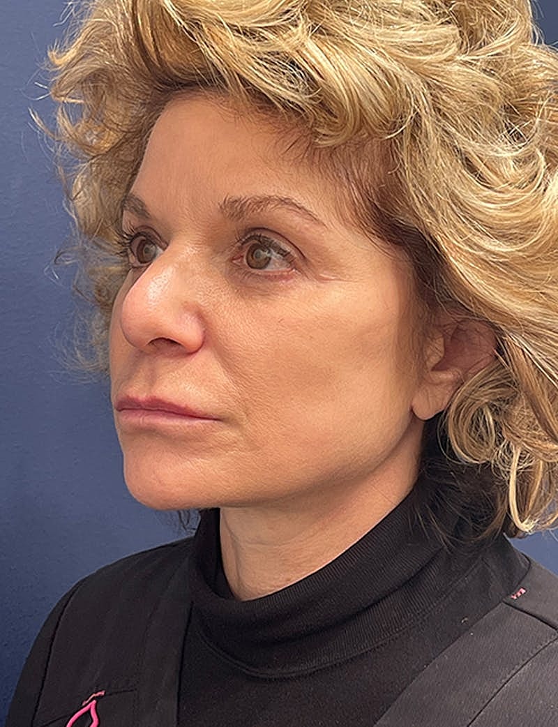 Dermal Fillers Before & After