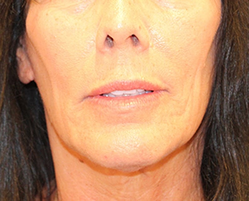 Dermal Fillers Before & After