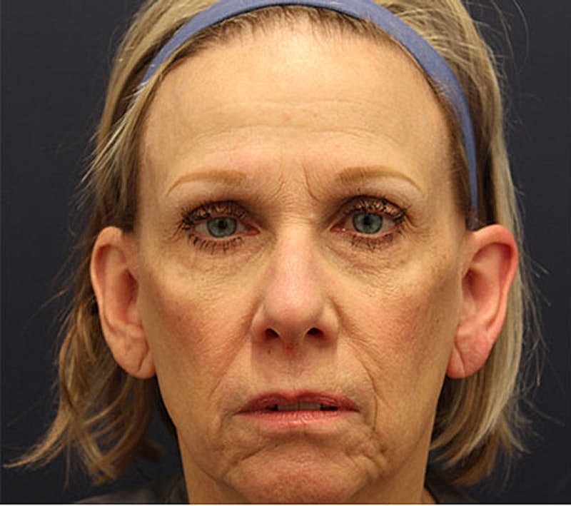 Otoplasty Before & After