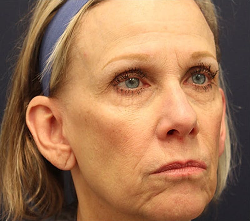 Otoplasty Before & After