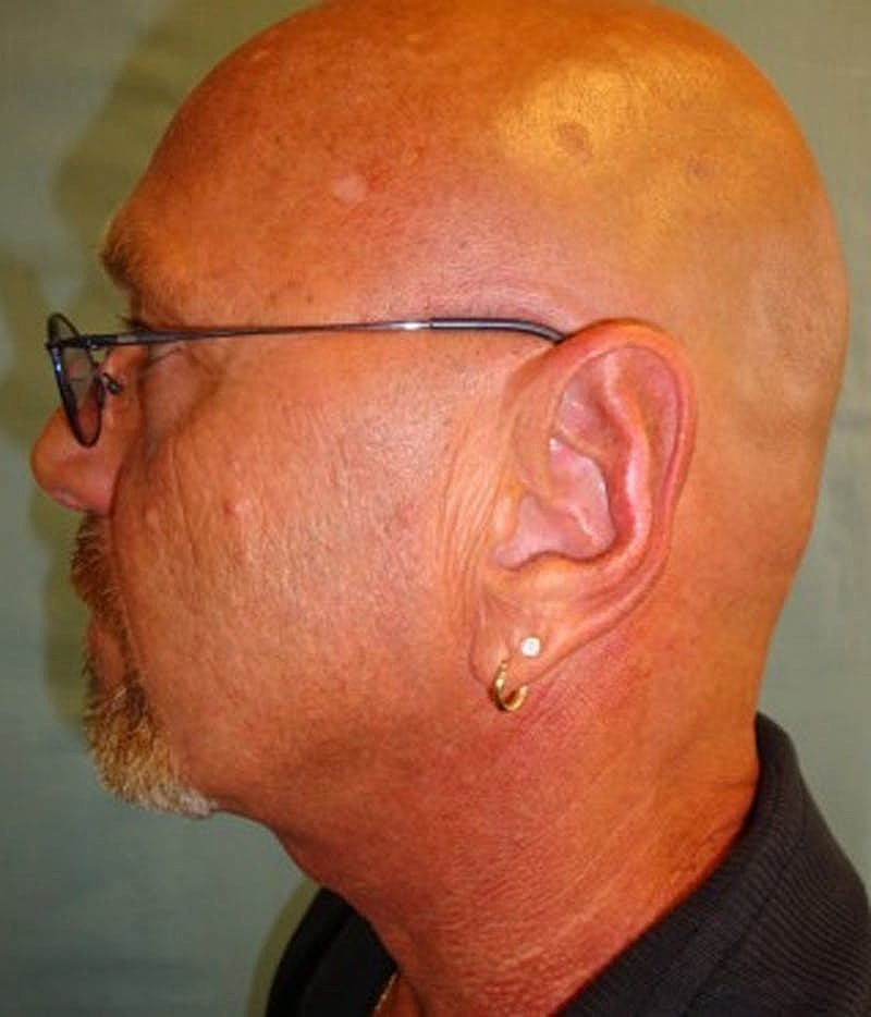 Otoplasty Before & After