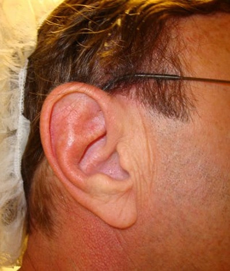 Otoplasty Before & After