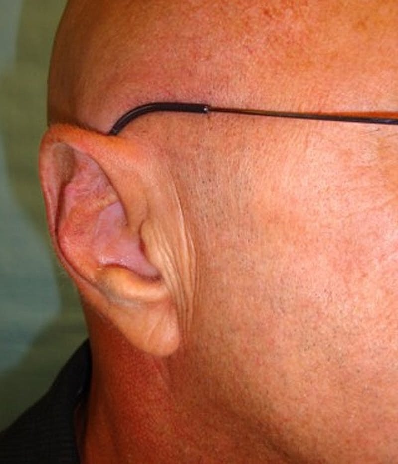 Otoplasty Before & After