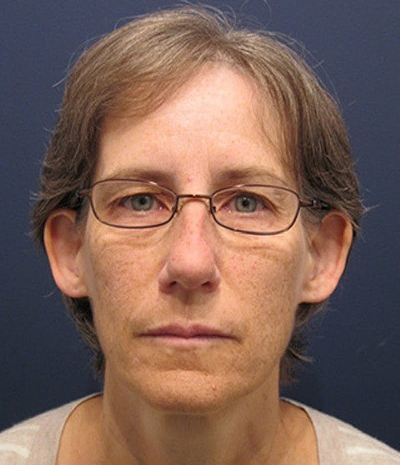 Otoplasty Before & After