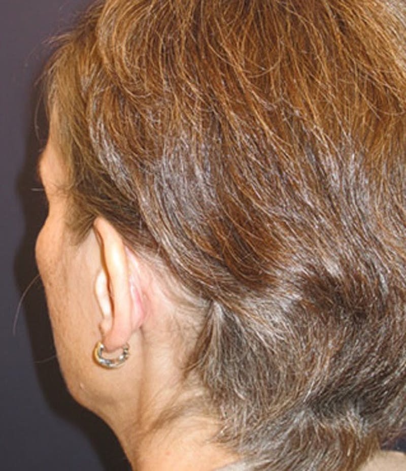 Otoplasty Before & After