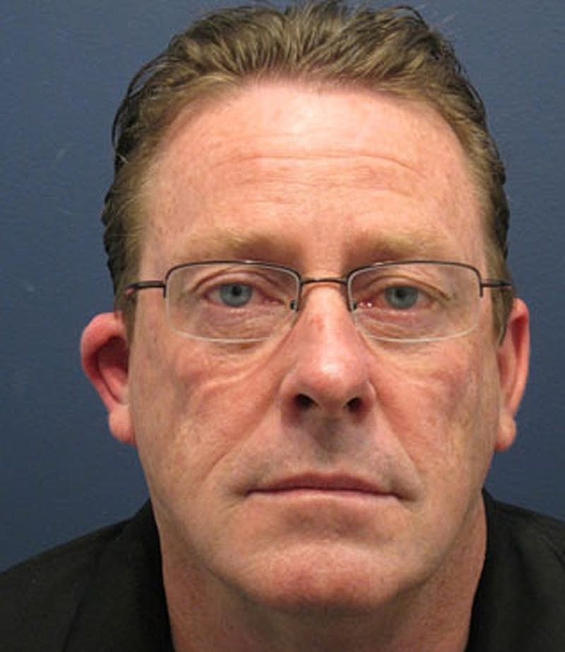 Otoplasty Before & After