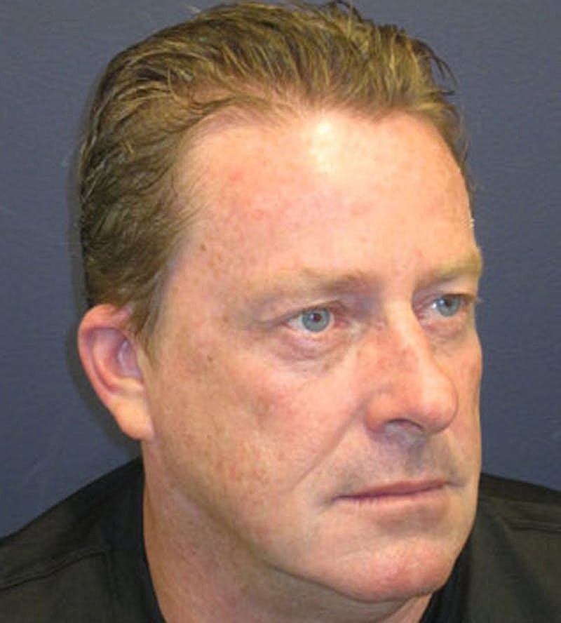 Otoplasty Before & After