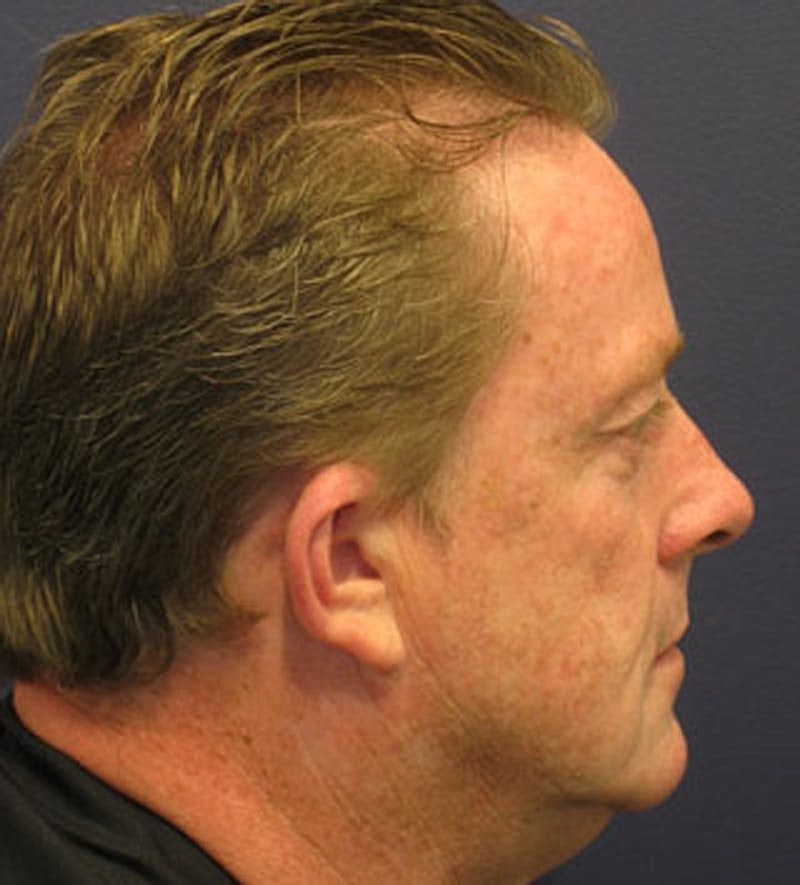 Otoplasty Before & After