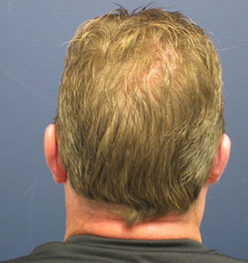 Otoplasty Before & After