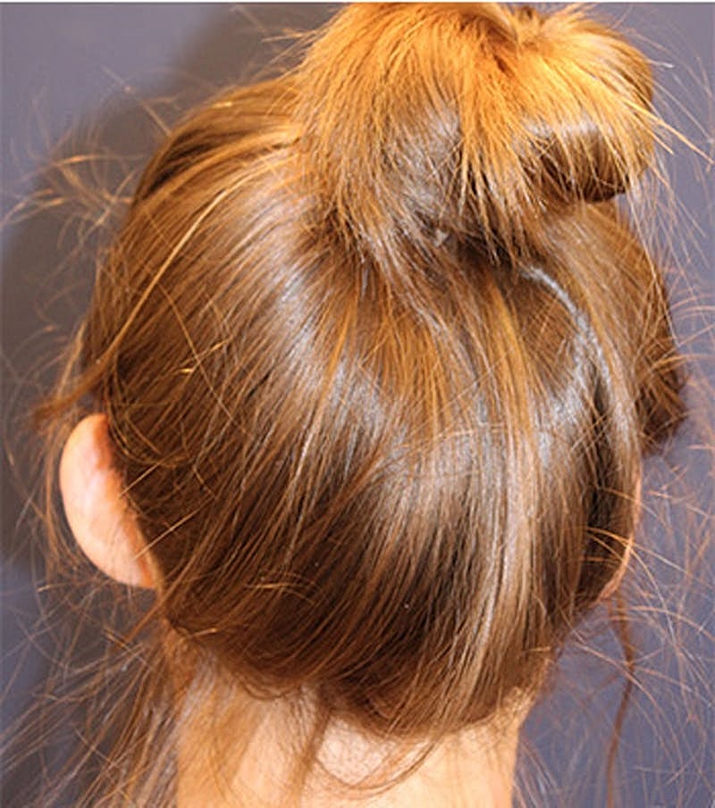 Otoplasty Before & After