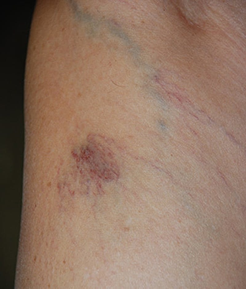 Spider Vein Treatment Before & After