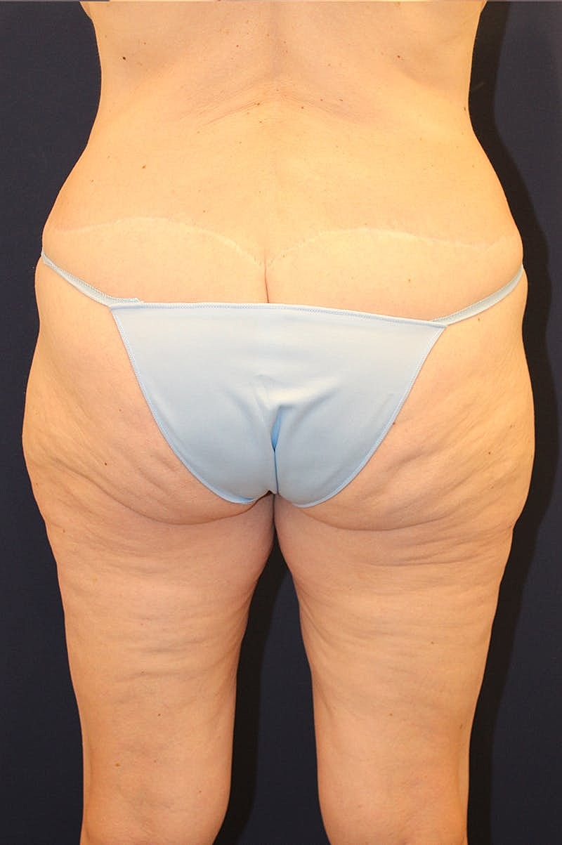 Massive Weight Loss Before & After