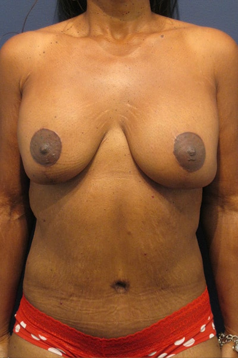 Massive Weight Loss Before & After