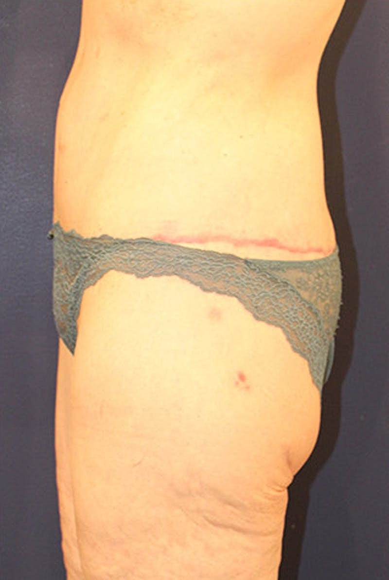 Massive Weight Loss Before & After