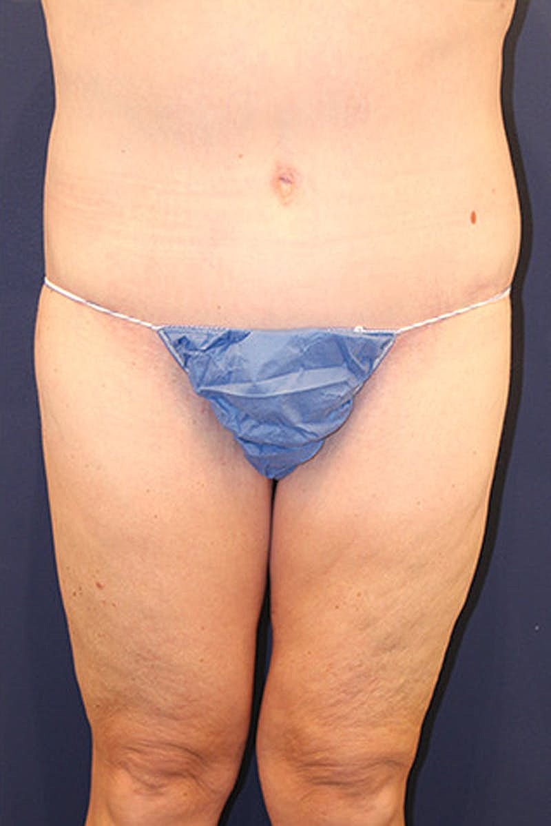 Massive Weight Loss Before & After