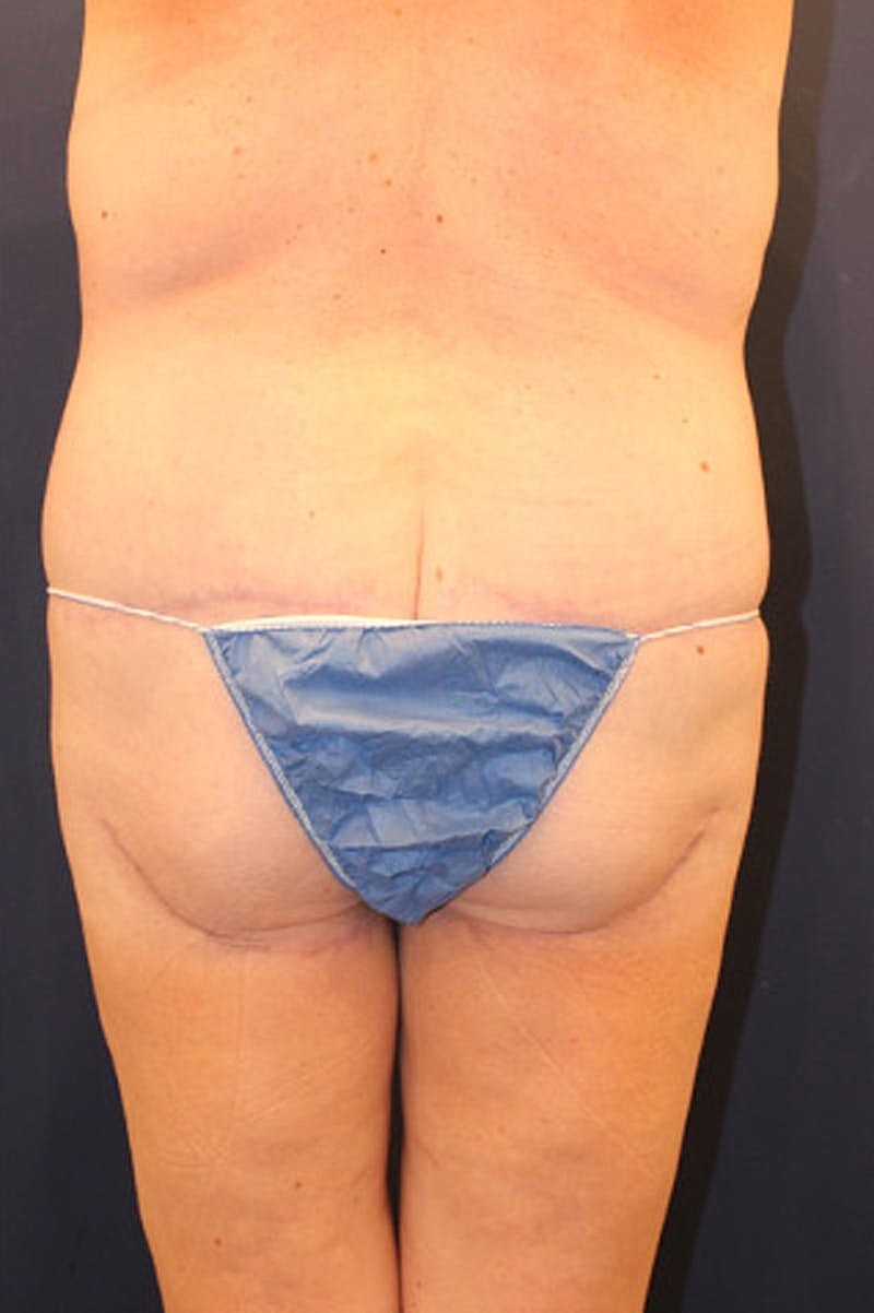 Massive Weight Loss Before & After