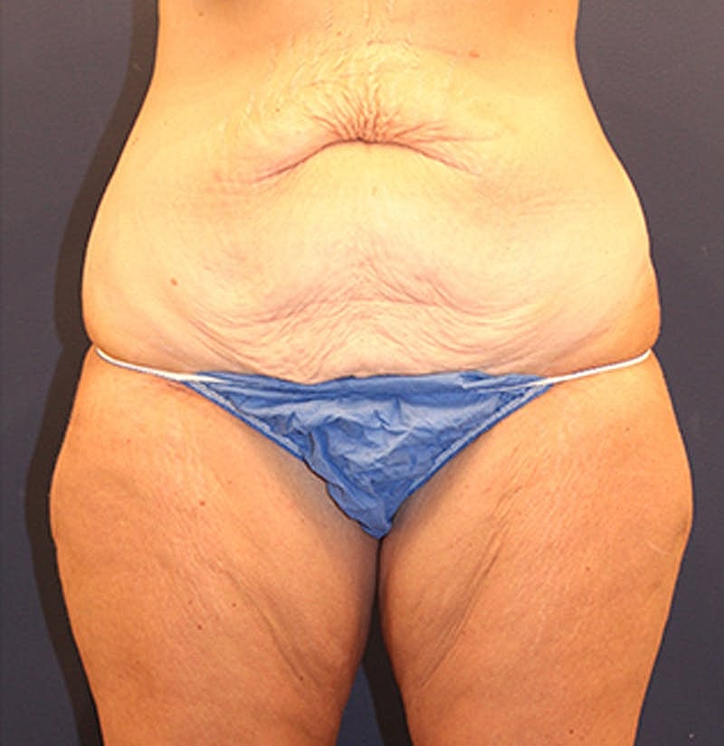 Massive Weight Loss Before & After