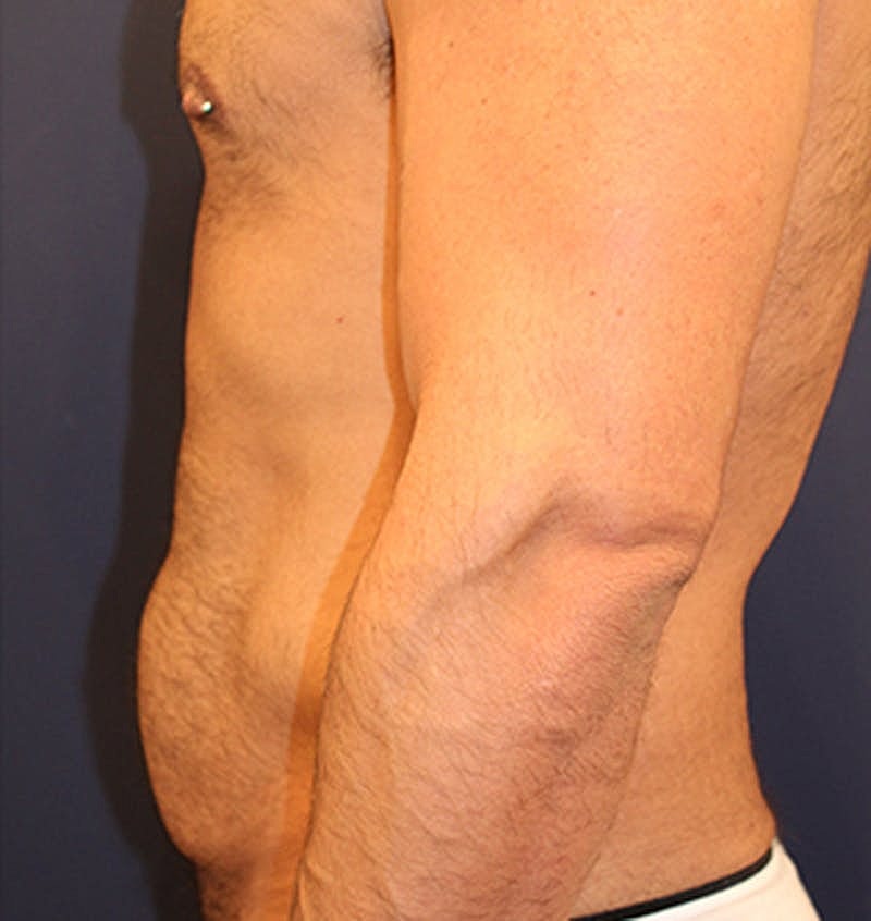 Massive Weight Loss Before & After