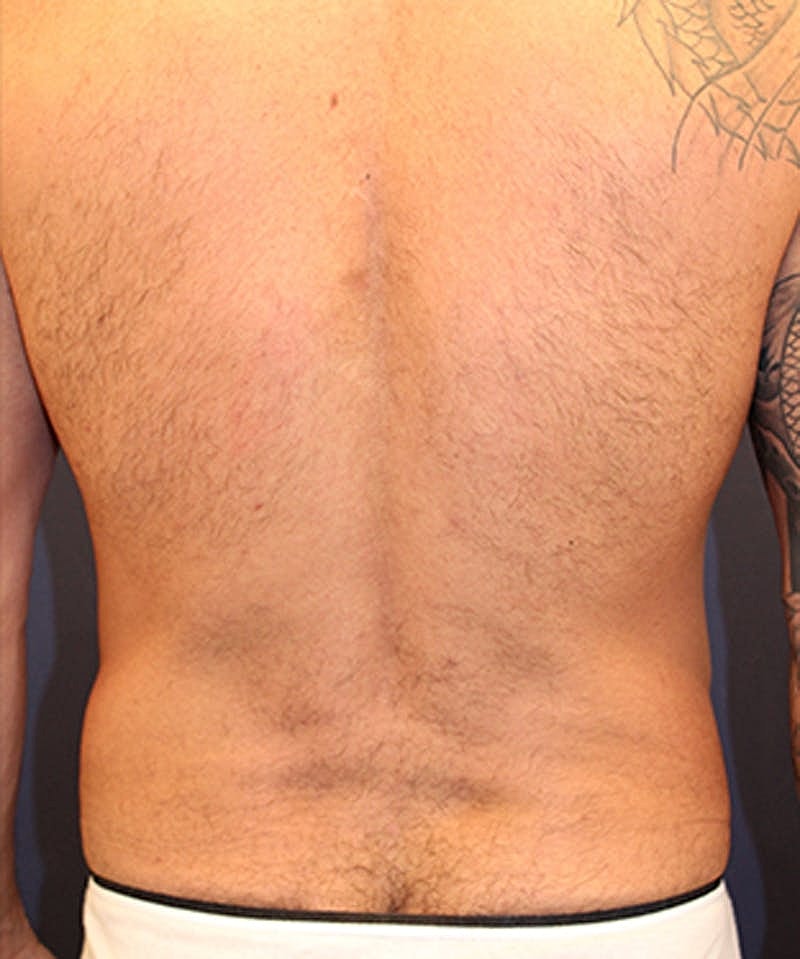 Massive Weight Loss Before & After