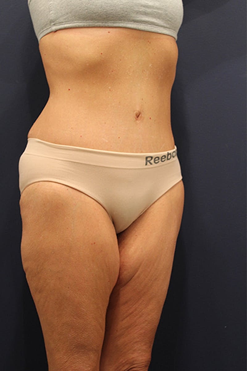 Massive Weight Loss Before & After