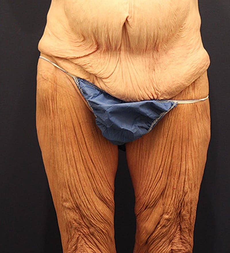 Massive Weight Loss Before & After