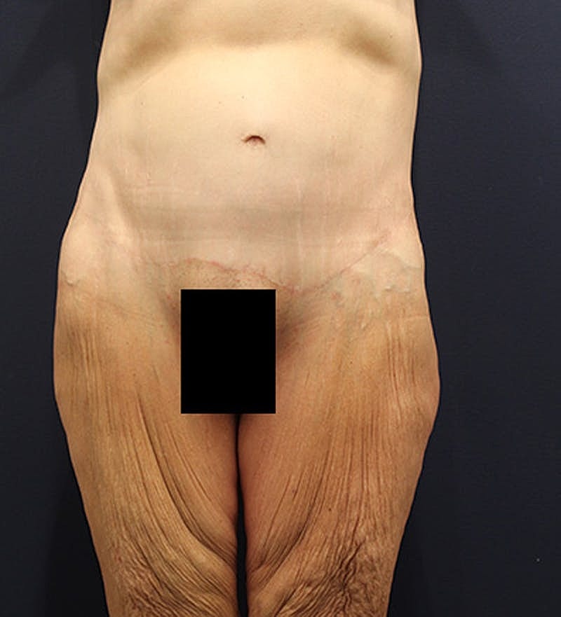 Massive Weight Loss Before & After