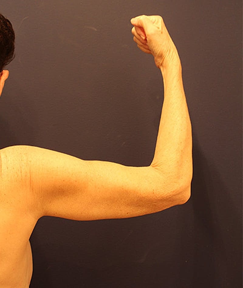 Massive Weight Loss Before & After