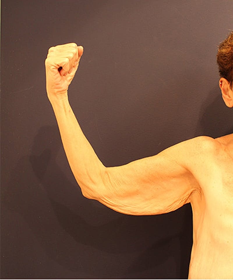 Massive Weight Loss Before & After