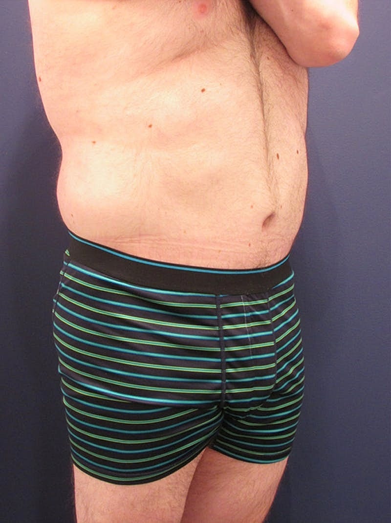 Massive Weight Loss Before & After