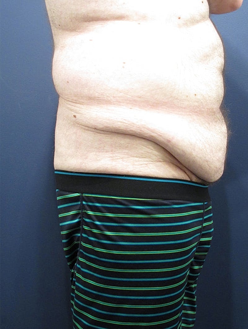 Massive Weight Loss Before & After