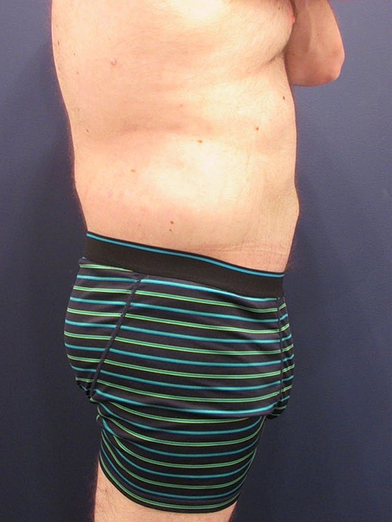 Massive Weight Loss Before & After