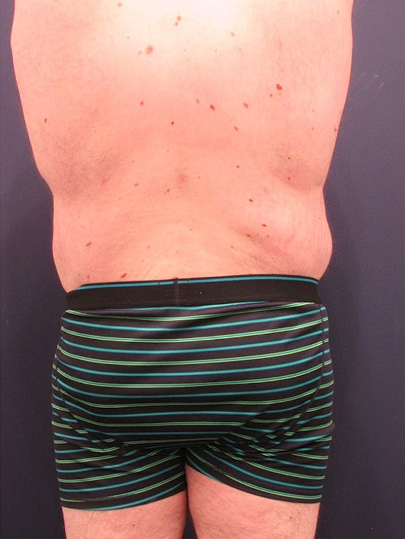 Massive Weight Loss Before & After