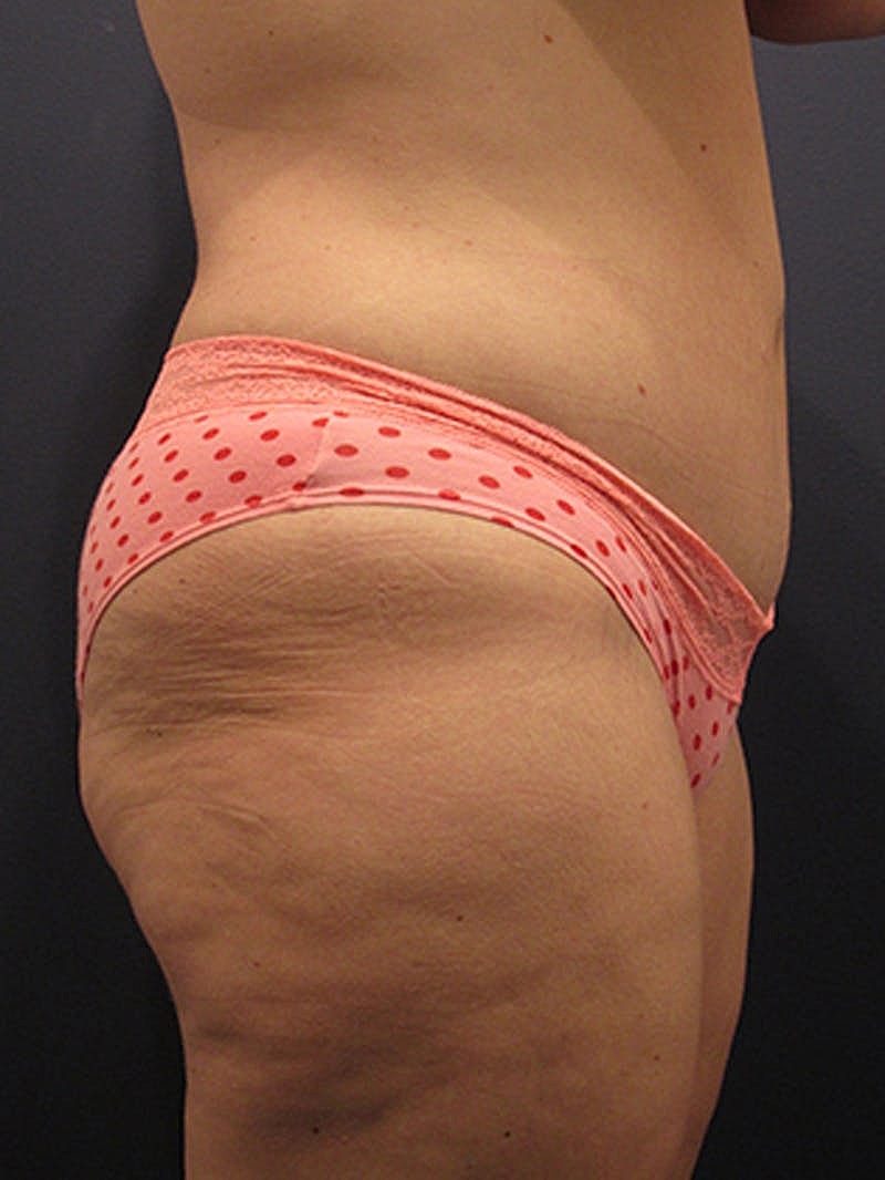 Massive Weight Loss Before & After