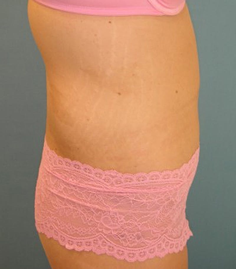 Massive Weight Loss Before & After