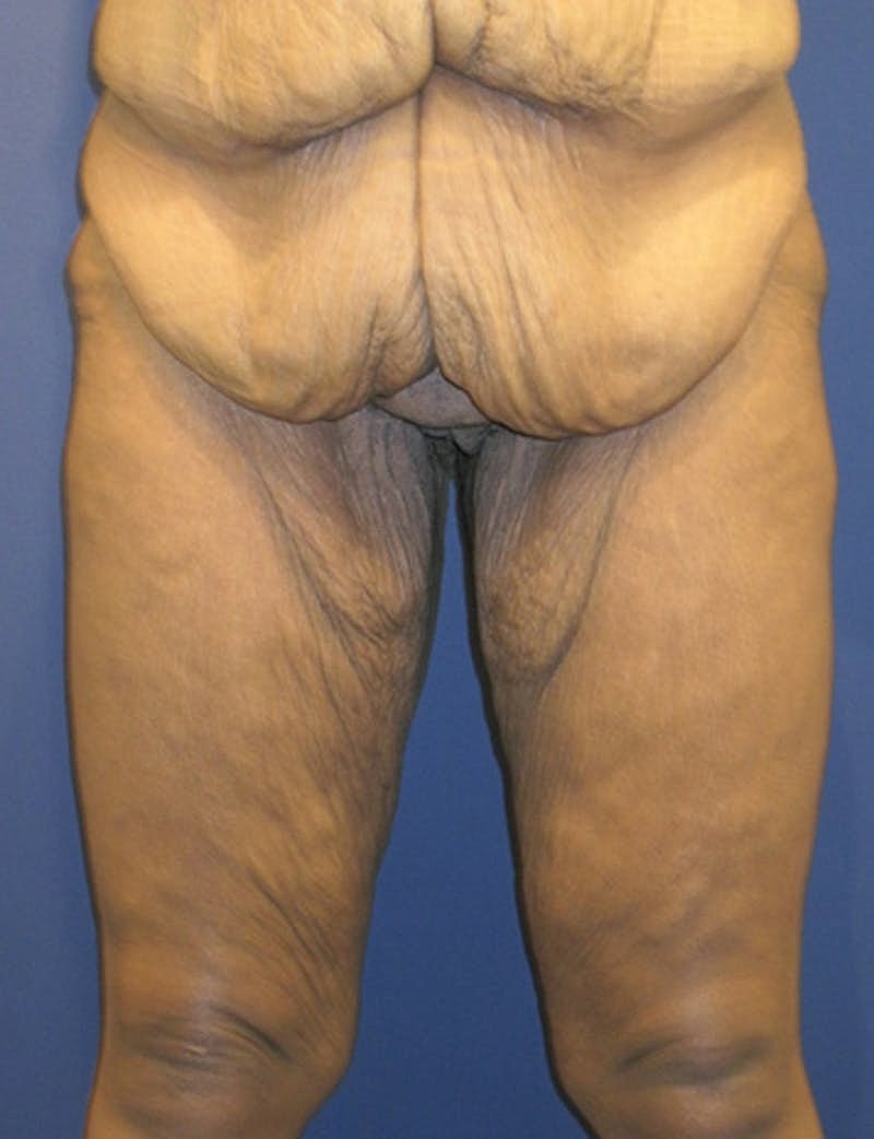 Massive Weight Loss Before & After