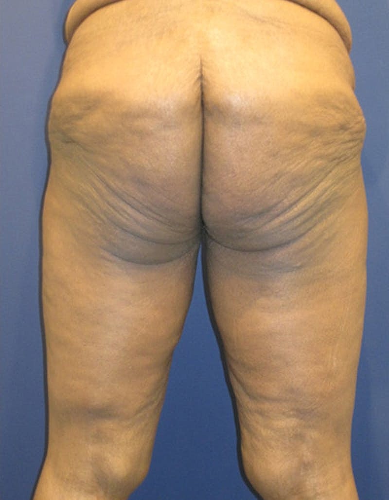 Massive Weight Loss Before & After