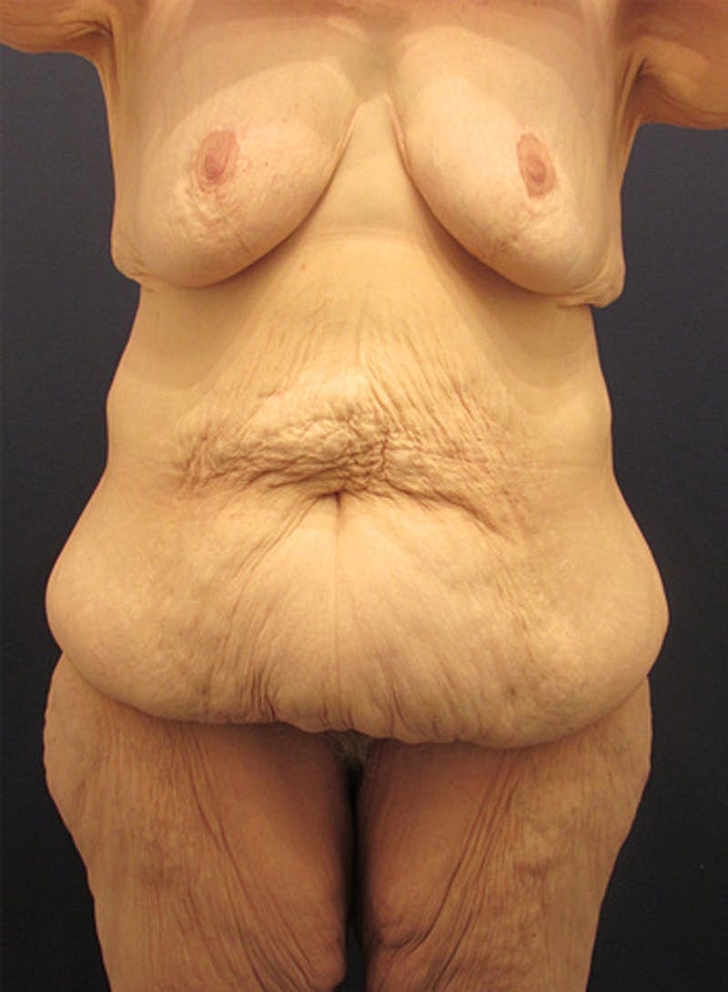 Massive Weight Loss Before & After